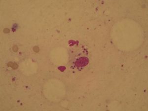 Fagocitosi. Macrofago con Leishmanie in biopsia cutanea - 1000x